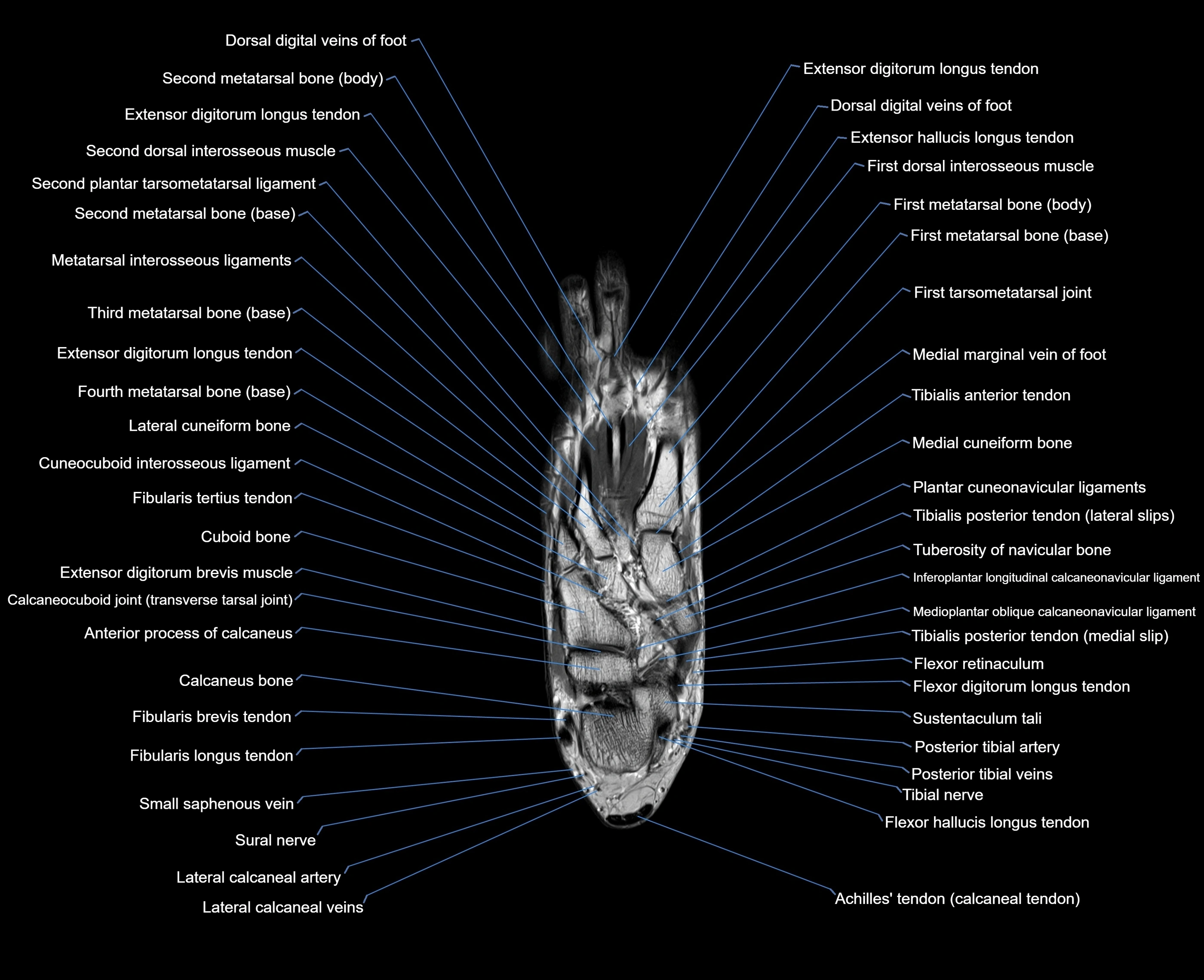 MRI foot coronal cross sectional anatomy 3T  radiology  image-img-00001-00018.webp